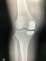 特発性大腿骨内顆骨壊死(UKA)症例(術後X線)